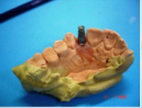 /album/galeria-de-fotos-carga-imediata-apos-exodontia-atraumatica-/carga-imediata-com-exodontia-atraumatica13-jpg/